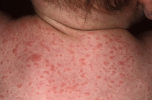 Roseola