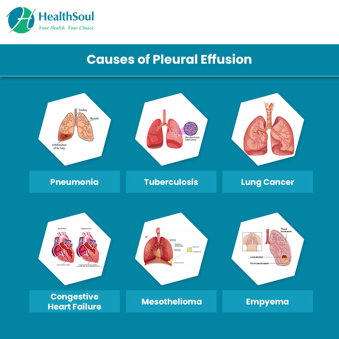 Pleural Effusion Detailed Pathophysiology Signs And Symptoms Treatment ...