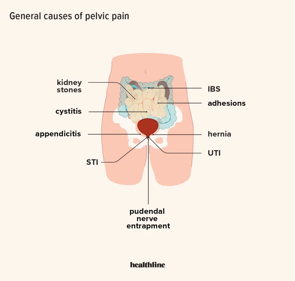 Bone pain in the pelvic area