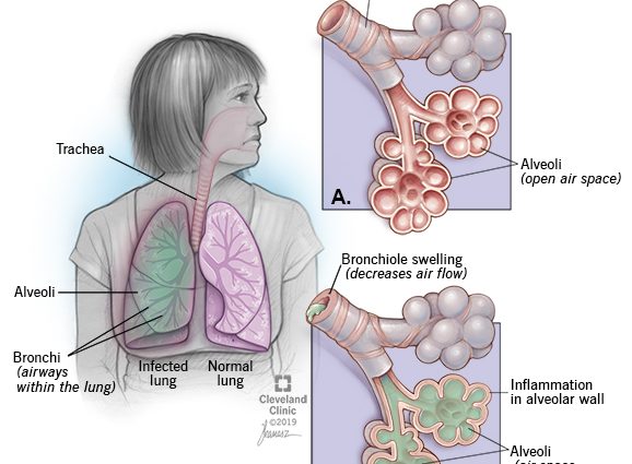 Viral pneumonia – causes, symptoms, diagnosis, treatment, prevention ...