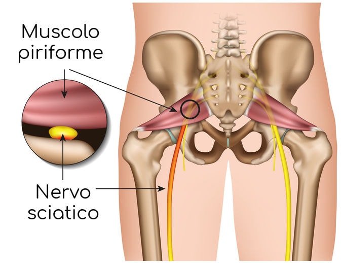 Sindrome del piriforme: cause, sintomi, esercizi e cura