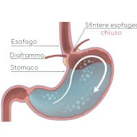 Acalasia esofagea: cause, sintomi, alimentazione e cura