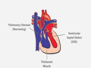 Tetralogy Of Fallot Surgery In India