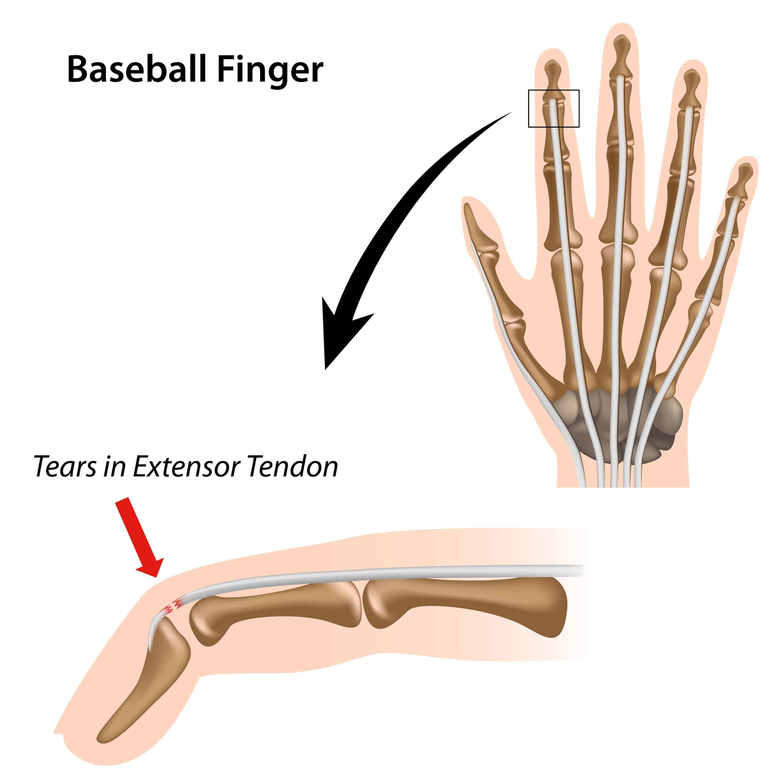 Finger Extensor Tendon Injury Definition Causes Sympt - vrogue.co