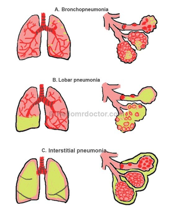 Bronchitis vs pneumonia lung sounds - assecommercial