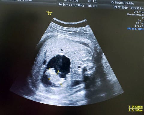 A Woman Gave Birth To A Baby With Twin Inside Her - Fetus In Fetu