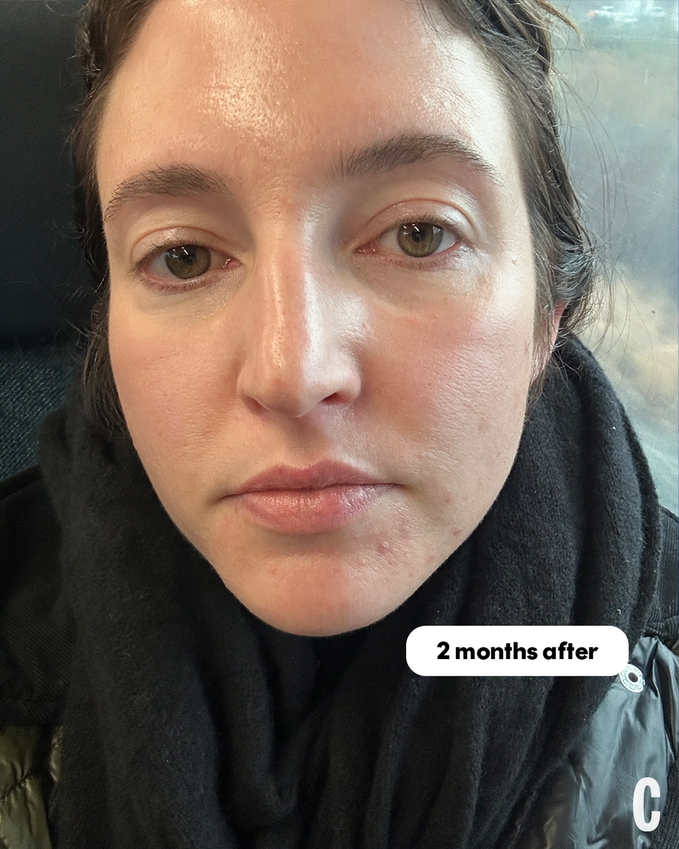 ultherapy before and after