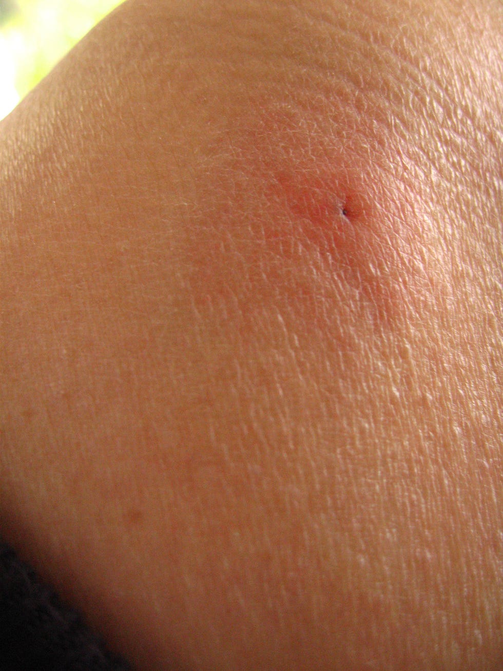 Tick Bite Pictures Symptoms What Does A Tick Bite Look, 40% OFF