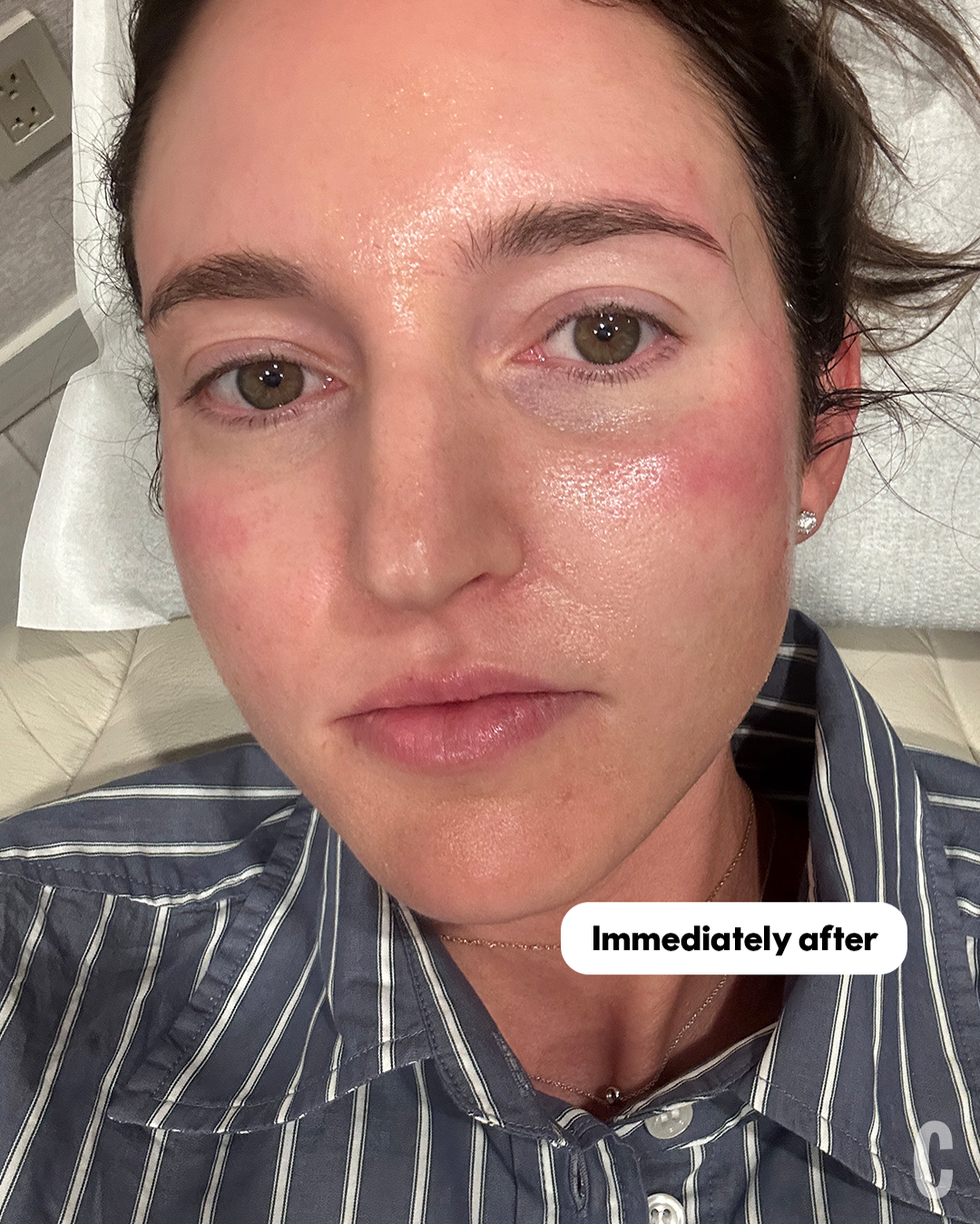 skin after ultherapy