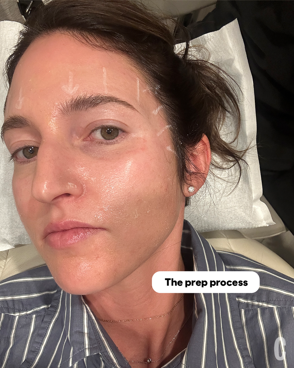 ultherapy prep process for skin