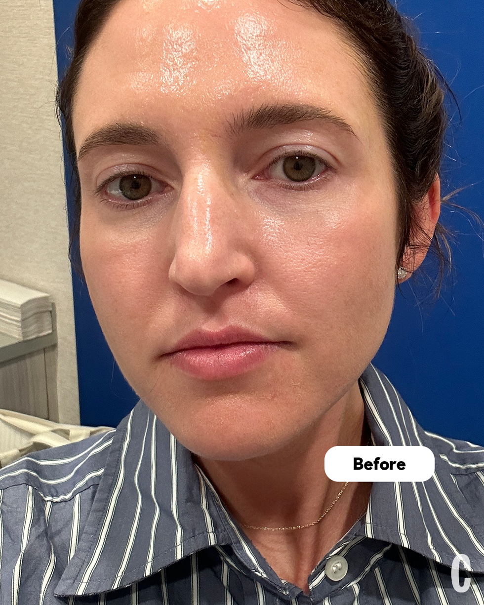 ultherapy before and after