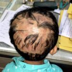 A case of Lichen Planopilaris in a boy got cured