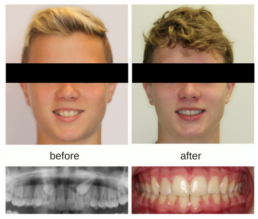 Correction of impacted canines with orthodontics