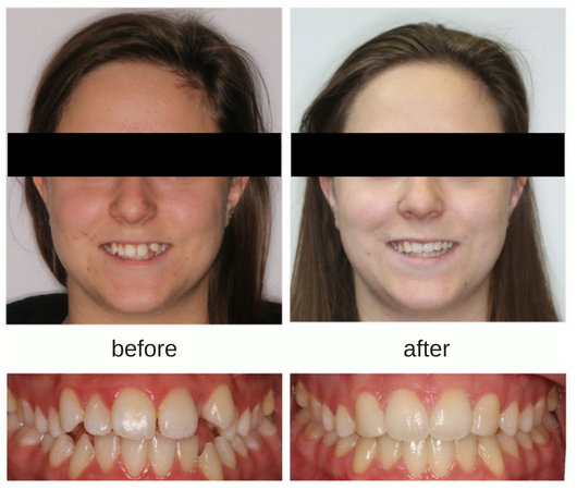 Before and After photo of Patient with missing tooth treated with braces in Mississauga