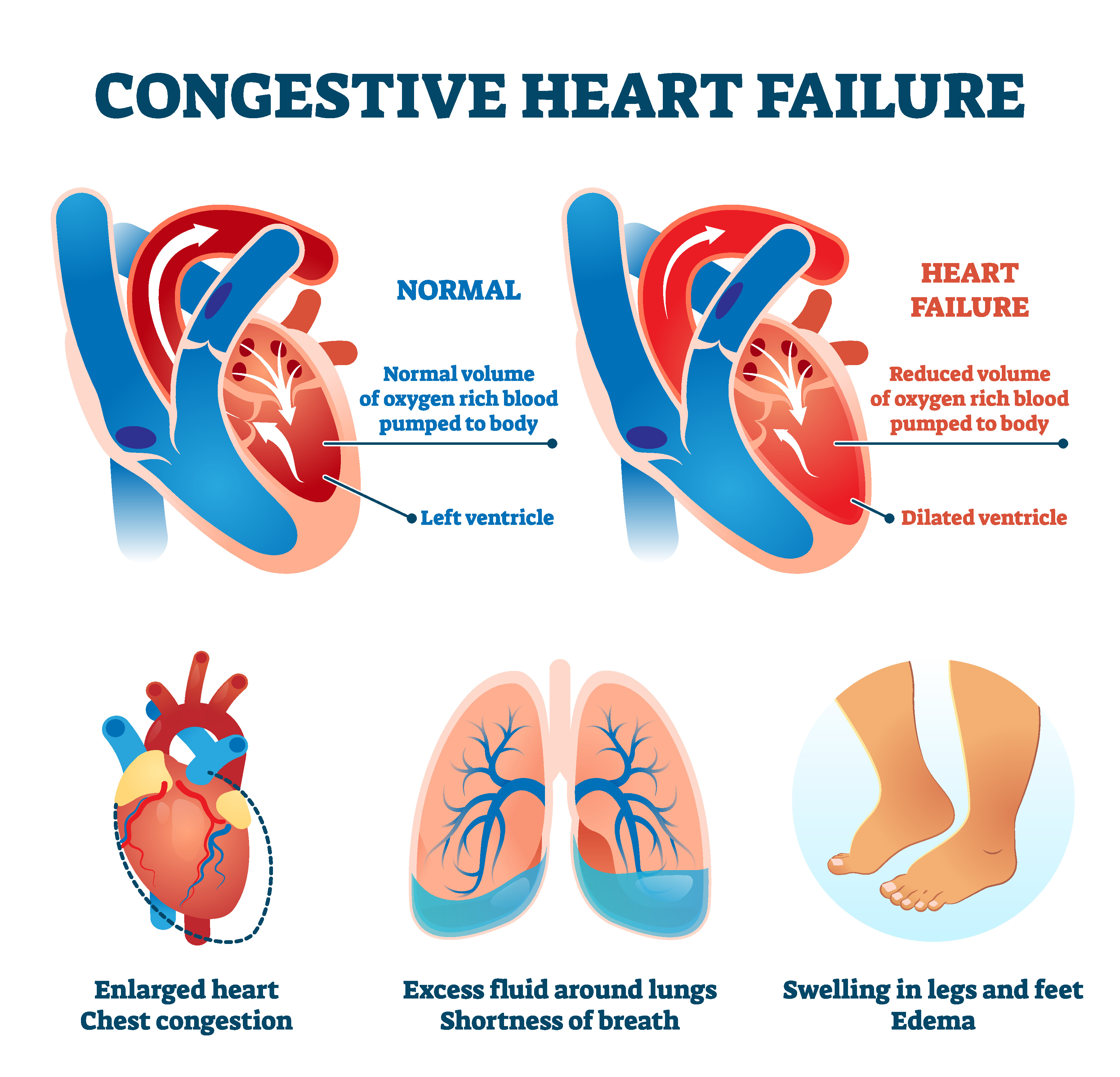 Congestive Heart Failure The Johns Hopkins Patient Guide To Diabetes ...