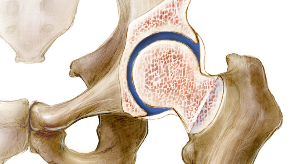 Hip Arthroscopy