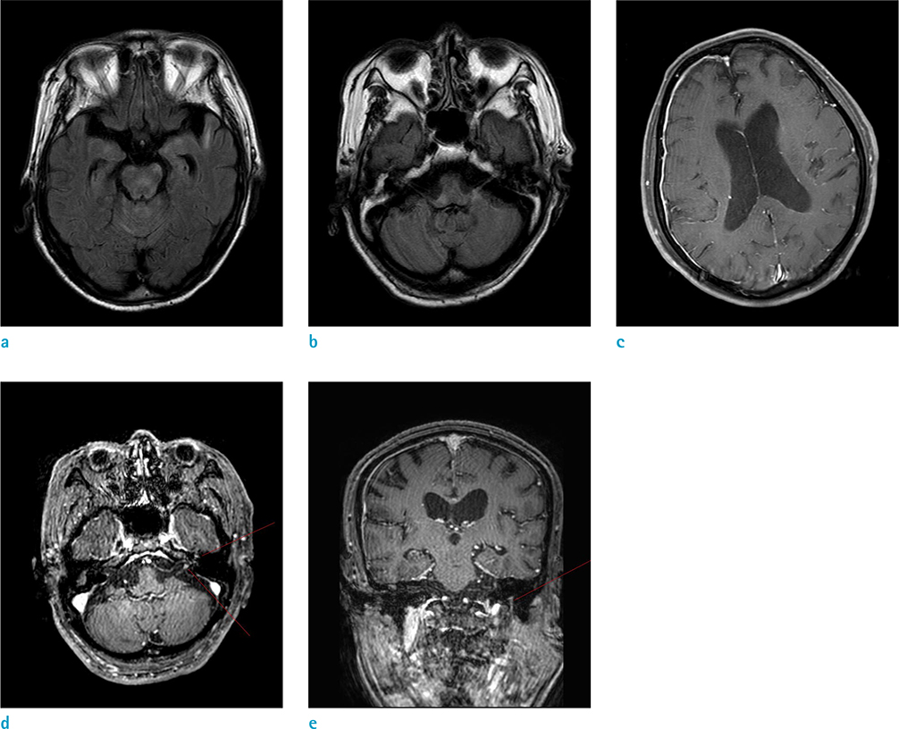 Ramsay Hunt Syndrome Complicated by Meningoencephalitis and Radiologic ...