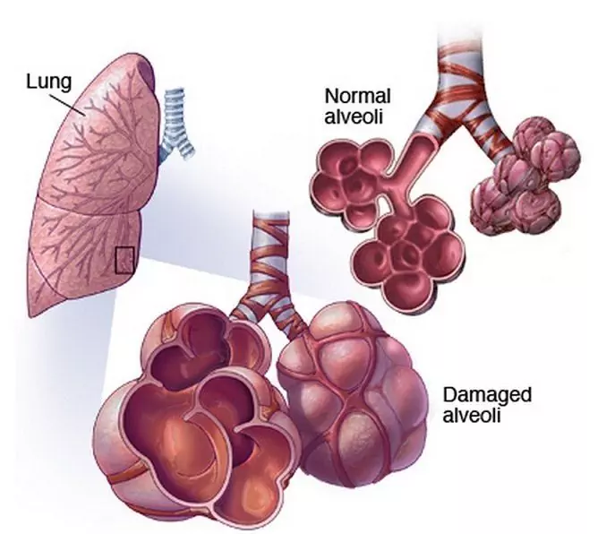 Alveolitis - Symptoms, Treatment, Complications, Lung Alveolitis ...