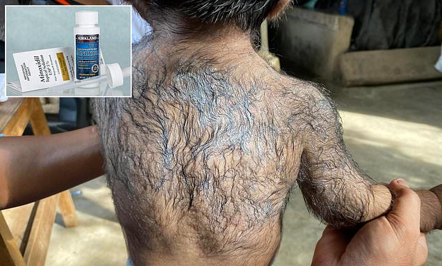 Concern as babies develop bizarre 'werewolf syndrome' after parents use popular hair loss