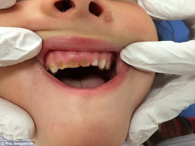 This child's teeth (pictured) have been eroded away by drinking sugary drinks on a regular basis. The Royal Children's Hospital National Child Health Poll said one in four children drank sugary drinks most days a week