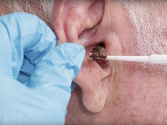 earwax removal