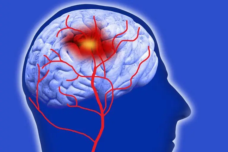 Ugonjwa wa Thalamic: ni nini, matibabu, ubashiri