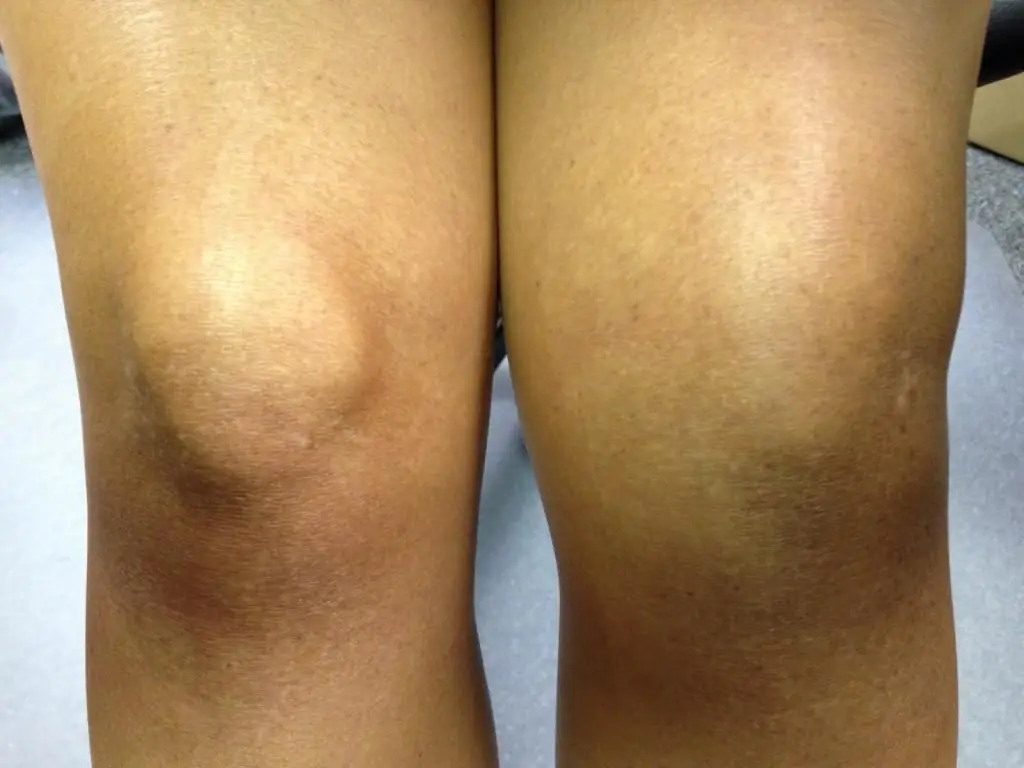 Knie-swelling: oorsake en behandelings