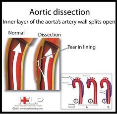 an image of the inner layer of the aortas artery wall splitts open