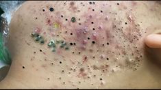 Chin Blackheads Removal, Pimple Poppìng Videos Blackheads, Staphylococci Bacteria Infection On Skin, Cystic Acne Removal Video, Spot Popping Videos, Pimple Pops Videos, Dr Pimple Poppìng Videos, Big Blackheads Removal Satisfying Videos, Skin Diseases Pictures