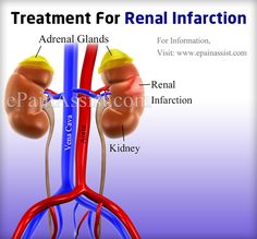 Treatment For Renal Infarction Adrenal Glands, Blood Flow, Medical Conditions, Signs