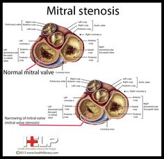 an image of the normal and abnormal heart valves