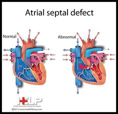 Atrial Septal Defect Cardiac Assessment, Neonatal Nursing, Atrial Septal Defect, Cardiac Disease, Premature Birth, Neonatal Nurse