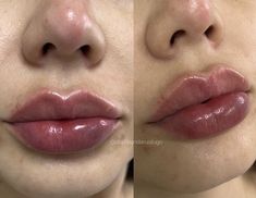 Nose Job And Lip Fillers, Butterfly Lip Filler, Perfect Lips Injections, M Shaped Lips, Lip Filler Aesthetic, Desired Lips, Pump Lips, Round Lips, Lip Filler Inspiration