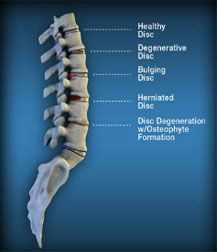 Back Pain Relief | If you have recurring issues with pain in your lower back, you may wish to begin a case review through North American Spine and discover how the laser spine procedure known as the AccuraScope™ D.N.D. procedure can transform your life. Chronic back pain lingers for several months or longer and often will not resolve without proper treatment. Workouts For Lower Back, Foraminal Stenosis, Exercise For Back Pain, Back Ache Relief, Dr Office, Severe Back Pain, Chronic Back Pain, Piriformis Syndrome, Natural Headache Remedies