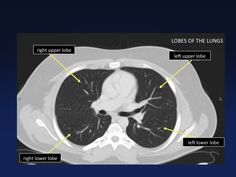 CSFoma, Peritoneal, Cerebrospinal, Fluid, Pseudocyst, csf, shunt ...