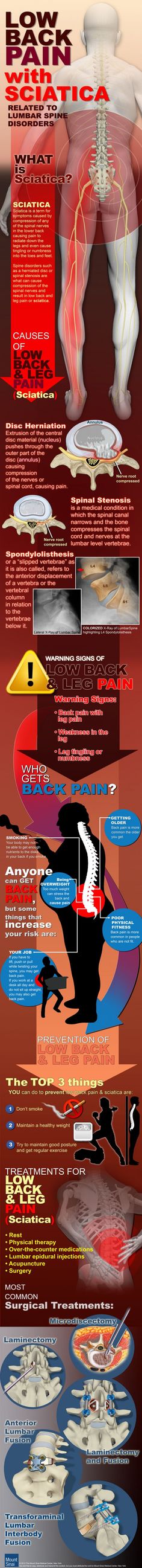 Low Back Pain, Sciatica causes. Many of these issues can be helped by just having proper posture and using a lumbar roll. Piriformis Syndrome Exercises, News Logo, Piriformis Syndrome, Sciatica Relief, Sciatica Pain Relief, Sciatic Nerve Pain, Sciatica Pain, Sciatic Nerve, Leg Pain