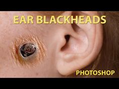 Pimple In Ear, Pimples In Ear, Poping Pimples Videos New, Huge Blackheads Extraction Videos, Ear Pimple Poppìng Videos, Black Heads Popping