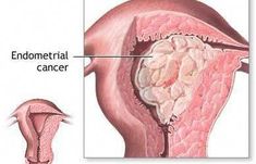 Learn how a secretory endometrial biopsy is performed before you have tissue samples taken from the lining of your uterus. Endometrial Carcinoma, Endometrial Hyperplasia, Fibroid Tumors, Female Health, Chest Workouts, Nclex, Ultrasound