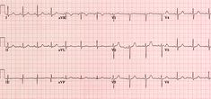 Pin on EKG