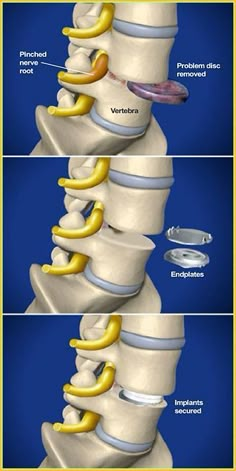 Nerve Root Blocks in Spine Surgery