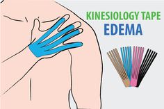 Kinesiology Tape #Edema Sports Taping, Foot Reflexology Massage, Reflexology Massage, Taiping, Foot Reflexology, Chronic Condition