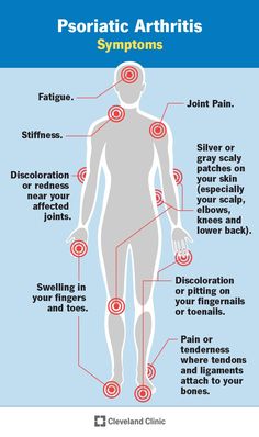 Psoriatic Arthritis: Symptoms and Treatments Achilles Pain, Skin Symptoms, Crps Awareness, Arthritic Pain, Degenerative Disease, Health Articles, Autoimmune Disease, Physical Health