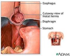 Bile Reflux, Heart Burn Remedy, Reflux Diet, Reflux Symptoms, Reflux Disease, Vagus Nerve, Chewing Gum, Acid Reflux, Health And Beauty Tips