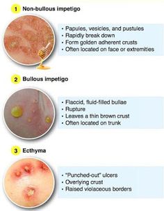 Basal Cell Carcinoma vs. Squamous Cell Carcinoma vs. Kaposi Sarcoma vs ...