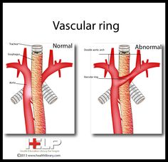 Vascular Ring Pediatric Echocardiography, Aortic Arch, Cardiac Sonography, Chd Awareness, Congenital Heart Defect, Heart Defect, Congenital Heart, Nurse Stuff, Work Project