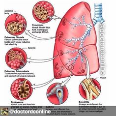 Pulmonary edema