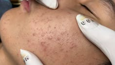 ACNE TREATMENT VU QUYNH MI| Acne On Teen's Chin 2024 Relaxing Moments, Blackheads, To Share