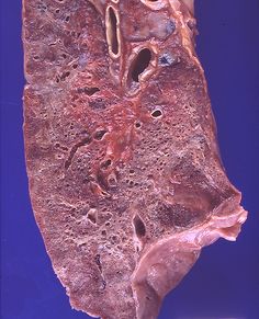 Stages Of Liver Fibrosis