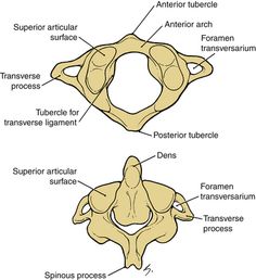 altas axis of the cervical spine. When out of alignment can cause your ...