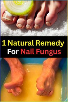 Natural ingredients may provide support for healthier nails. #nailcare #naturalwellness Fungal Infection Remedies, Foot Soak Recipe, Nail Remedies, Alopecia Hairstyles, Toenail Fungus Remedies, Nail Fungus Remedy, Nail Infection, Natural Face Skin Care, Fungal Nail